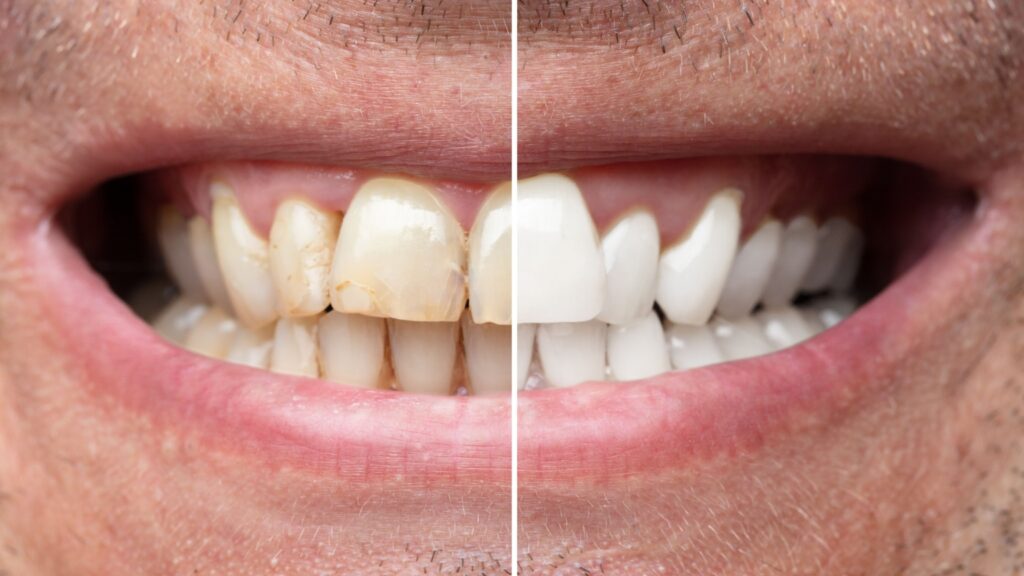 Teeth Whitening
